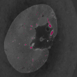 Medical imaging segmentation overlay 3
